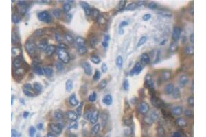 Detection of KRT33A in Human Liver cancer Tissue using Polyclonal Antibody to Keratin 33A (KRT33A)