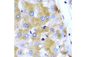 Immunohistochemical analysis of GNT1 staining in human liver cancer formalin fixed paraffin embedded tissue section. (Ugt1 anticorps)