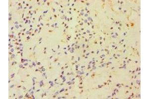 Immunohistochemistry of paraffin-embedded human breast cancer using ABIN7154834 at dilution of 1:100