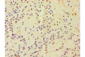 Immunohistochemistry of paraffin-embedded human breast cancer using ABIN7154834 at dilution of 1:100 (HAUS3 anticorps  (AA 384-603))