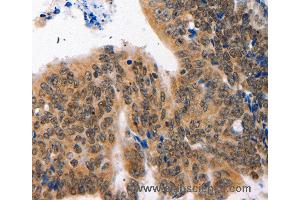 Immunohistochemistry of Human colon cancer using NAIF1 Polyclonal Antibody at dilution of 1:60 (NAIF1 anticorps)