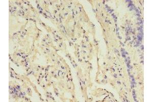 Immunohistochemistry of paraffin-embedded human lung tissue using ABIN7157832 at dilution of 1:100 (B3GNT5 anticorps  (AA 65-344))