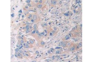 DAB staining on fromalin fixed paraffin- embedded breast cancer tissue) (UBE2S anticorps  (AA 1-209))