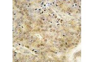 IHC analysis of FFPE human prostate carcinoma tissue stained with EZH1 antibody (EZH1 anticorps  (AA 393-422))
