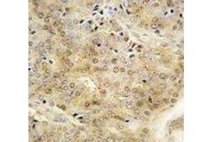 IHC analysis of FFPE human prostate carcinoma tissue stained with EZH1 antibody