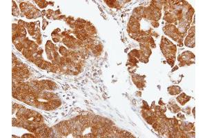 IHC-P Image Immunohistochemical analysis of paraffin-embedded human gastric, using TDP1, antibody at 1:100 dilution. (TDP1 anticorps)