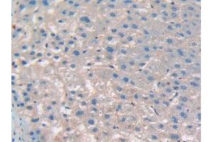 IHC-P analysis of Human Liver Cancer Tissue, with DAB staining. (CD276 anticorps  (AA 47-219))