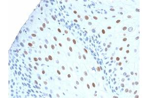 Formalin-fixed, paraffin-embedded human Urothelial Carcinoma stained with p21 Rabbit Recombinant Monoclonal Antibody (CIP1/2275R).