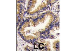 Formalin-fixed and paraffin-embedded human lung carcinoma tissue reacted with URM1 polyclonal antibody  , which was peroxidase-conjugated to the secondary antibody, followed by DAB staining. (Urm1 anticorps  (N-Term))