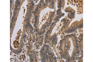 Immunohistochemistry of Human colon cancer using KCNA7 Polyclonal Antibody at dilution of 1:40