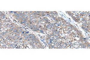 Immunohistochemistry of paraffin-embedded Human liver cancer tissue using XIRP1 Polyclonal Antibody at dilution of 1:90(x200) (XIRP1 anticorps)