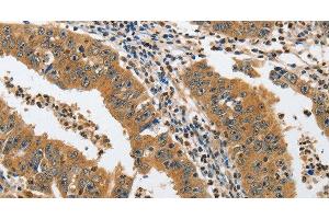 Immunohistochemistry of paraffin-embedded Human gastric cancer tissue using PIK3R3 Polyclonal Antibody at dilution 1:45 (PIK3R3 anticorps)