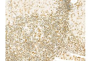 SCXA Antibody at 1/100 staining Human breast cancer by IHC-P. (SCXA anticorps  (Internal Region))