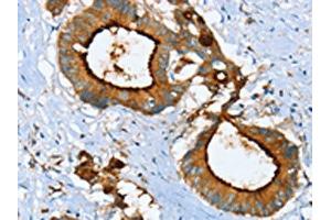 The image on the left is immunohistochemistry of paraffin-embedded Human colon cancer tissue using ABIN7130083(LGALS3BP Antibody) at dilution 1/25, on the right is treated with fusion protein. (LGALS3BP anticorps)