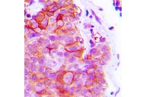 Immunohistochemical analysis of Alpha-2C Adrenergic Receptor staining in human breast cancer formalin fixed paraffin embedded tissue section.