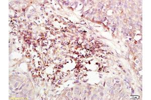 Formalin-fixed and paraffin embedded human lung carcinoma labeled with Anti-CD184/CXCR4 Polyclonal Antibody , Unconjugated at 1:200, followed by conjugation to the secondary antibody and DAB staining