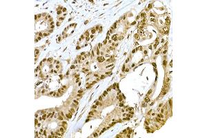 Immunohistochemistry of paraffin-embedded human colon carcinoma using METTL16 Rabbit pAb (ABIN7268501) at dilution of 1:100 (40x lens). (METTL16 anticorps  (AA 263-562))
