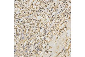 Immunohistochemistry of paraffin-embedded human kidney cancer using PRDX4 antibody at dilution of 1:200 (x400 lens) (Peroxiredoxin 4 anticorps)