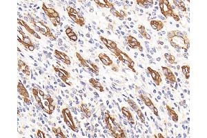 Immunohistochemistry analysis of paraffin-embedded human stomach cancer using CK-7 Monoclonal Antibody at dilution of 1:300. (Cytokeratin 7 anticorps)