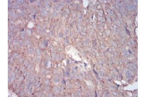 Immunohistochemical analysis of paraffin-embedded ovarian cancer tissues using RALA mouse mAb with DAB staining.
