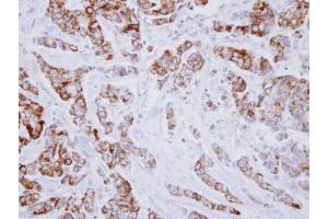 IHC-P Image Immunohistochemical analysis of paraffin-embedded human breast cancer, using IVD, antibody at 1:250 dilution. (IVD anticorps)