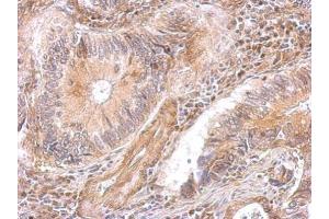IHC-P Image DAP5 antibody [C2C3], C-term detects EIF4G2 protein at cytosol on human gastric cancer by immunohistochemical analysis. (EIF4G2 anticorps  (C-Term))