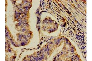 Immunohistochemistry of paraffin-embedded human endometrial cancer using ABIN7159328 at dilution of 1:100