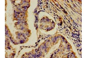 Immunohistochemistry of paraffin-embedded human endometrial cancer using ABIN7159328 at dilution of 1:100 (AOC3 anticorps  (AA 27-259))