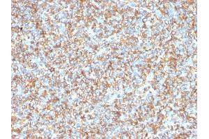 Formalin-fixed, paraffin-embedded human Ewing's Sarcoma stained with Vimentin Mouse Monoclonal Antibody (VM1170). (Vimentin anticorps)
