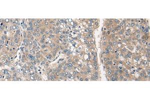 Immunohistochemistry of paraffin-embedded Human liver cancer tissue using CLIC6 Polyclonal Antibody at dilution of 1:40(x200) (CLIC6 anticorps)