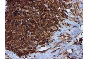 Immunohistochemical staining of paraffin-embedded Adenocarcinoma of Human breast tissue using anti-C1S mouse monoclonal antibody. (C1S anticorps)