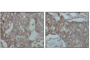 Immunohistochemical analysis of paraffin-embedded human breast carcinoma tissues, showing membrane localization with DAB staining using CD44 mouse mAb.