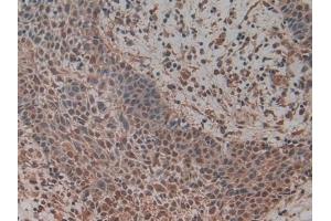 Detection of MCM5 in Human Skin cancer Tissue using Polyclonal Antibody to Minichromosome Maintenance Deficient 5 (MCM5)