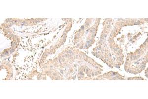Immunohistochemistry of paraffin-embedded Human thyroid cancer tissue using ERGIC3 Polyclonal Antibody at dilution of 1:50(x200) (ERGIC3 anticorps)