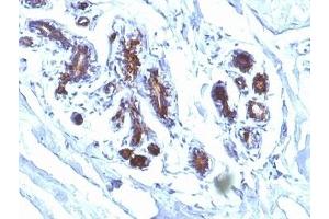 Formalin-fixed, paraffin-embedded human breast carcinoma stained with Lactadherin antibody (EDM45) (MFGE8 anticorps)