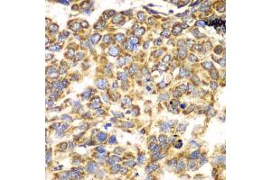Immunohistochemistry of paraffin-embedded human esophageal cancer using TOMM20 antibody (ABIN5974102) at dilution of 1/100 (40x lens). (TOMM20 anticorps)