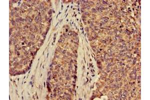Immunohistochemistry of paraffin-embedded human ovarian cancer using ABIN7170127 at dilution of 1:100
