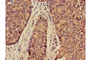 Immunohistochemistry of paraffin-embedded human ovarian cancer using ABIN7170127 at dilution of 1:100 (SLC2A9 anticorps  (AA 473-511))