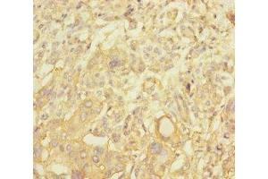 Immunohistochemistry of paraffin-embedded human pancreatic cancer using ABIN7161254 at dilution of 1:100 (NBAS anticorps  (AA 1-70))