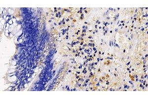 Detection of TMPRSS2 in Human Colorectal cancer Tissue using Polyclonal Antibody to Transmembrane Protease, Serine 2 (TMPRSS2) (TMPRSS2 anticorps  (AA 284-492))