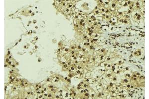 ABIN6267183 at 1/100 staining Human breast cancer tissue by IHC-P. (SQSTM1 anticorps  (pSer349))