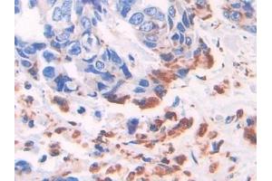 Detection of ADRP in Human Breast cancer Tissue using Polyclonal Antibody to Adipose Differentiation Related Protein (ADRP)