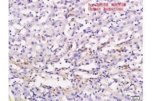 Formalin-fixed and paraffin embedded human liver cancer labeled with Anti ADCY10 Polyclonal Antibody, Unconjugated (ABIN751093) followed by conjugation to the secondary antibody and DAB staining
