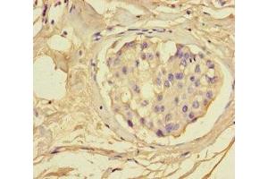 Immunohistochemistry of paraffin-embedded human breast cancer using ABIN7153665 at dilution of 1:100 (Non-Syndromic Hearing Impairment Protein 5 (GSDME) (AA 1-496) anticorps)