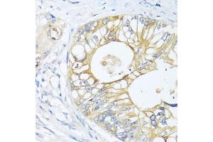Immunohistochemistry of paraffin-embedded human colon carcinoma using GNAI3 antibody. (GNAI3 anticorps)
