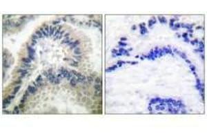 Immunohistochemical analysis of paraffin-embedded human lung carcinoma tissue using Guanylate Cyclase β antibody. (GUCY1B3 anticorps)