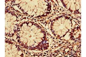 Immunohistochemistry of paraffin-embedded human colon cancer using ABIN7144591 at dilution of 1:100