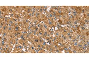 Immunohistochemistry of paraffin-embedded Human liver cancer using TRIM34 Polyclonal Antibody at dilution of 1:30 (TRIM34 anticorps)