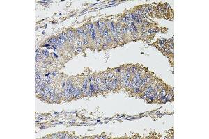 Immunohistochemistry of paraffin-embedded human colon carcinoma using UBE2S antibody.