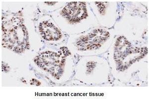Paraffin embedded sections of human breast cancer tissue were incubated with anti-human PPM1G (1:50) for 2 hours at room temperature. (PPM1G anticorps)